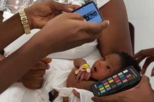 Une application de détection de la jaunisse pourrait sauver des vies Une application de détection de la jaunisse pourrait sauver des vies