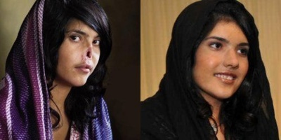 Aisha #Mohammadzai dévoile son nouveau nez Aisha #Mohammadzai dévoile son nouveau nez