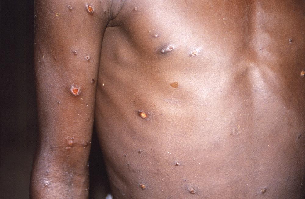 Les Africains voient une iniquité dans la réponse au monkeypox ailleurs Les Africains voient une iniquité dans la réponse au monkeypox ailleurs