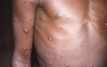 Les Africains voient une iniquité dans la réponse au monkeypox ailleurs Les Africains voient une iniquité dans la réponse au monkeypox ailleurs